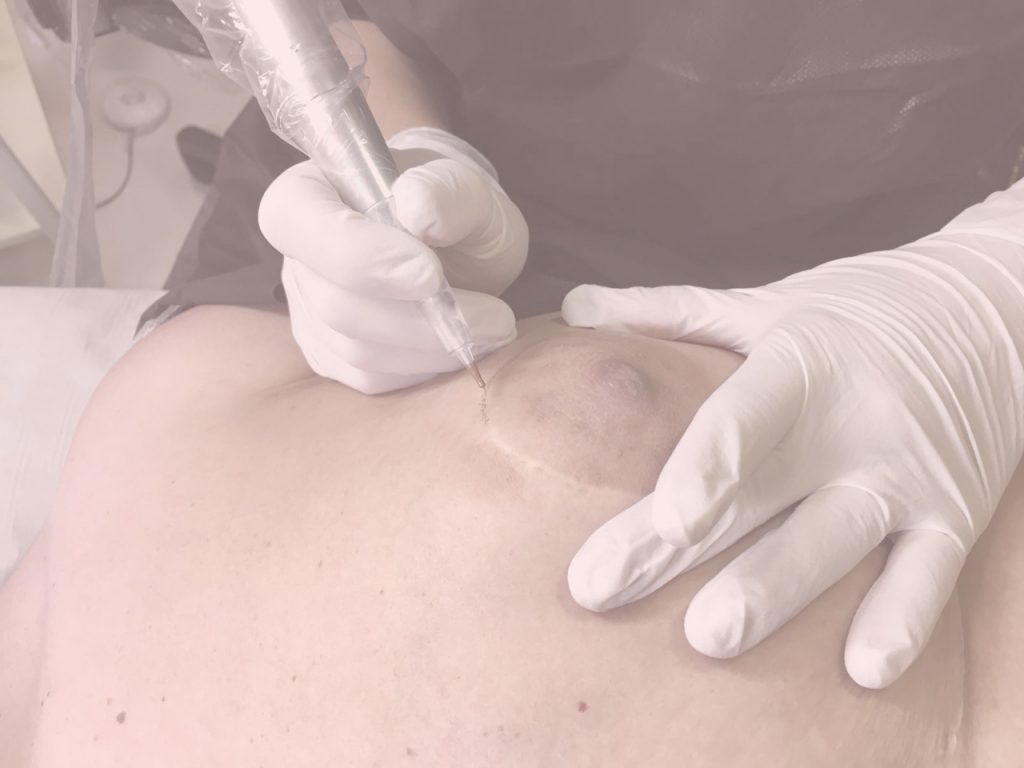 Micropigmentación mamaria