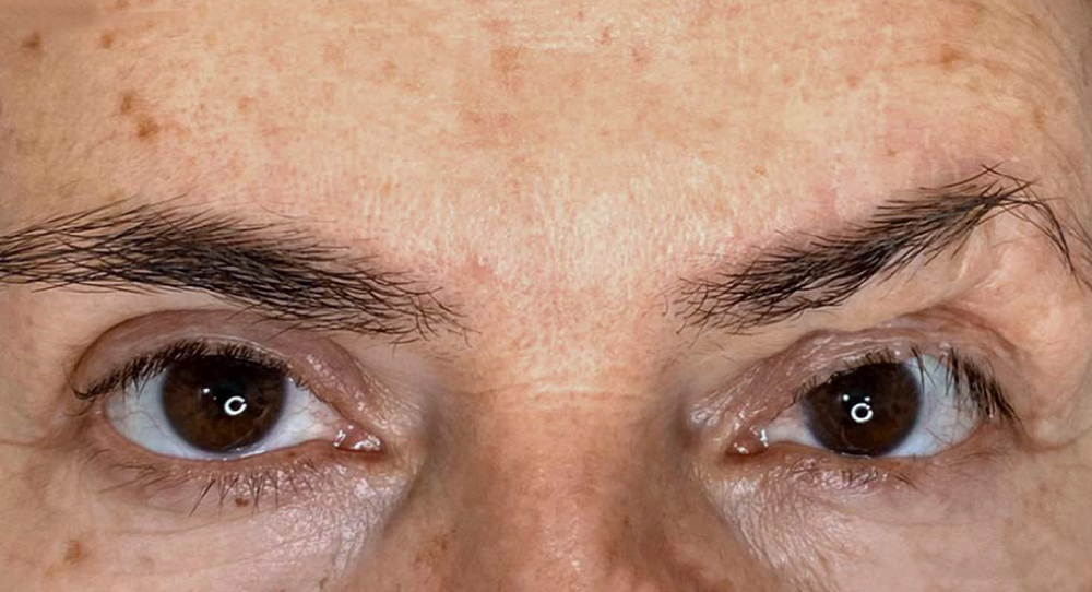 camuflaje-de-cicatrices-en-la-cara