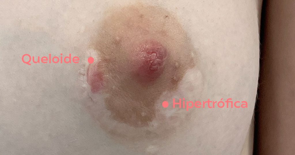 Differences between keloids and hypertrophic scars