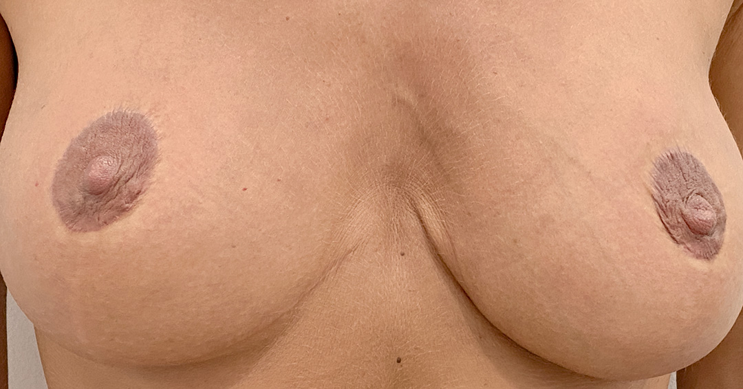 disimular-cicatrices-del-pezon