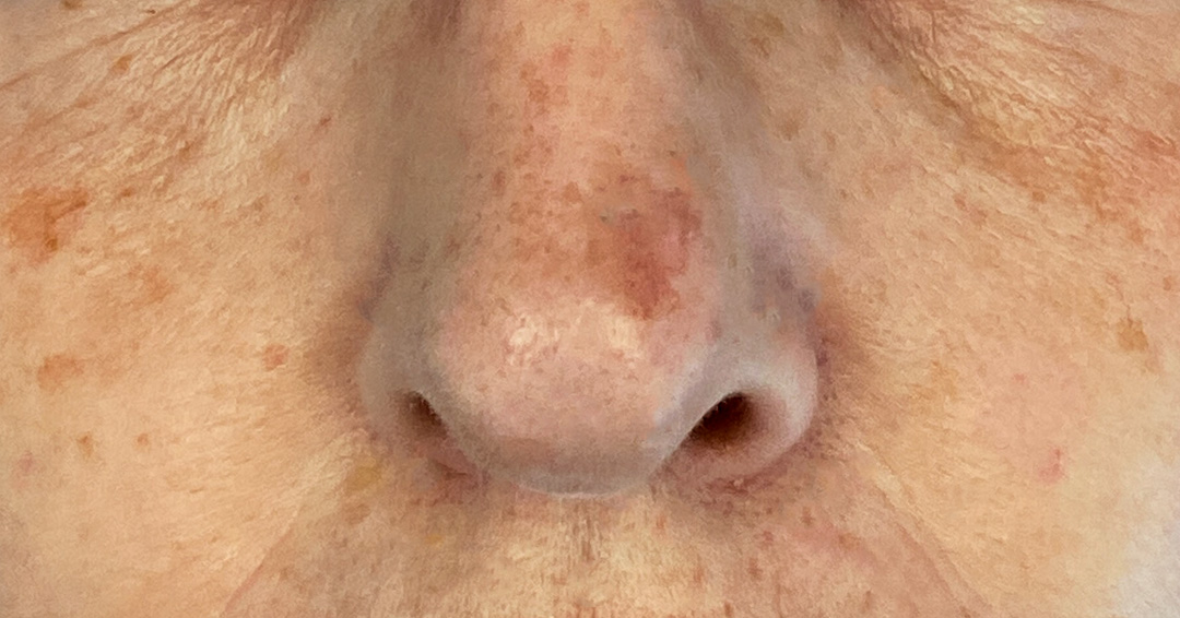 eliminar-manchas-oscuras-en-la-cara