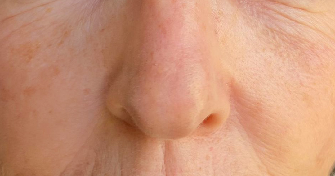 tratamiento-de-manchas-faciales