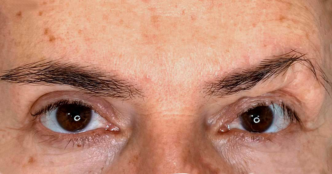 micropigmentacion-de-cicatrices-en-la-cara