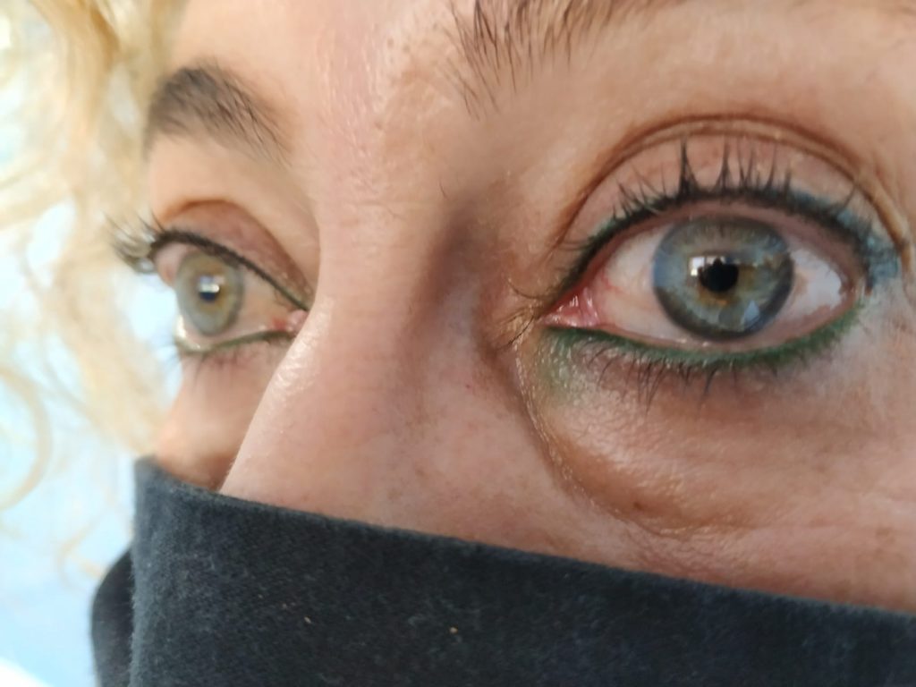 Realizado incorrectamente por otro profesional, migración de pigmento en el lagrimal.