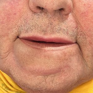 Hyperrealistic oncological tattoo for oral cavity reconstruction after oral cancer