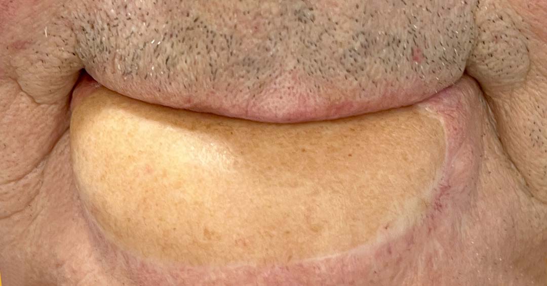 tatuaje-oncologico-cancer-de-boca2