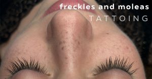 micropigmentation of freckles and moles