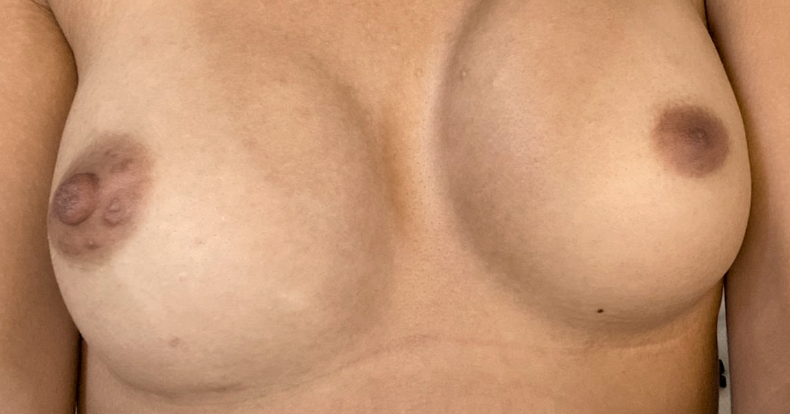 1.tatuaje-sindrome-de-poland