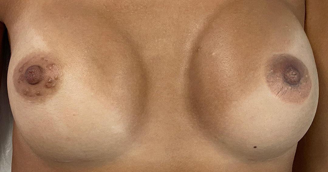 2.tatuaje-areola-sindrome-de-poland