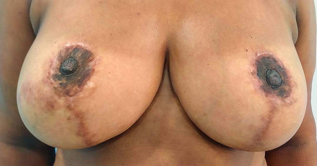 camuflage-de-cicatrices-postquirurgicas-en-arelas(1)