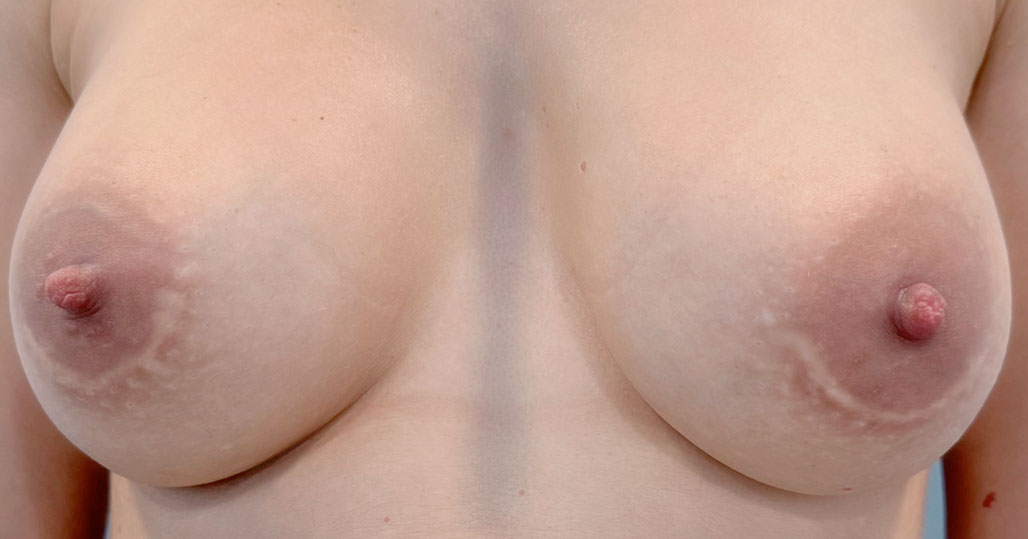 camuflar-cicatrices-en-la-aureola-en-barcelona