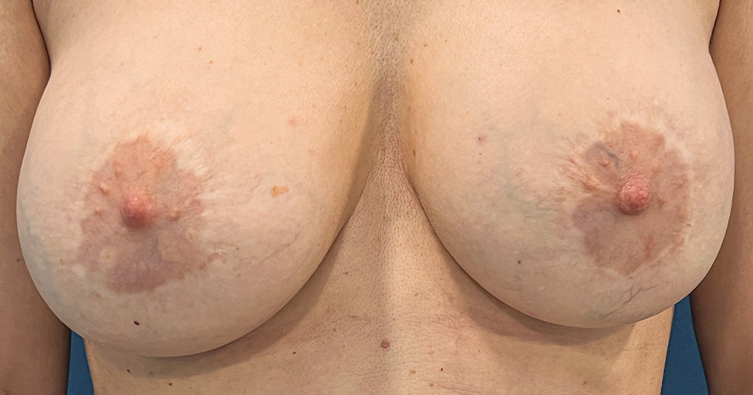 camuflar-cicatrices-en-la-aureola