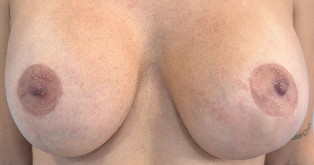 eliminar-cicatrices-en-la-aureola