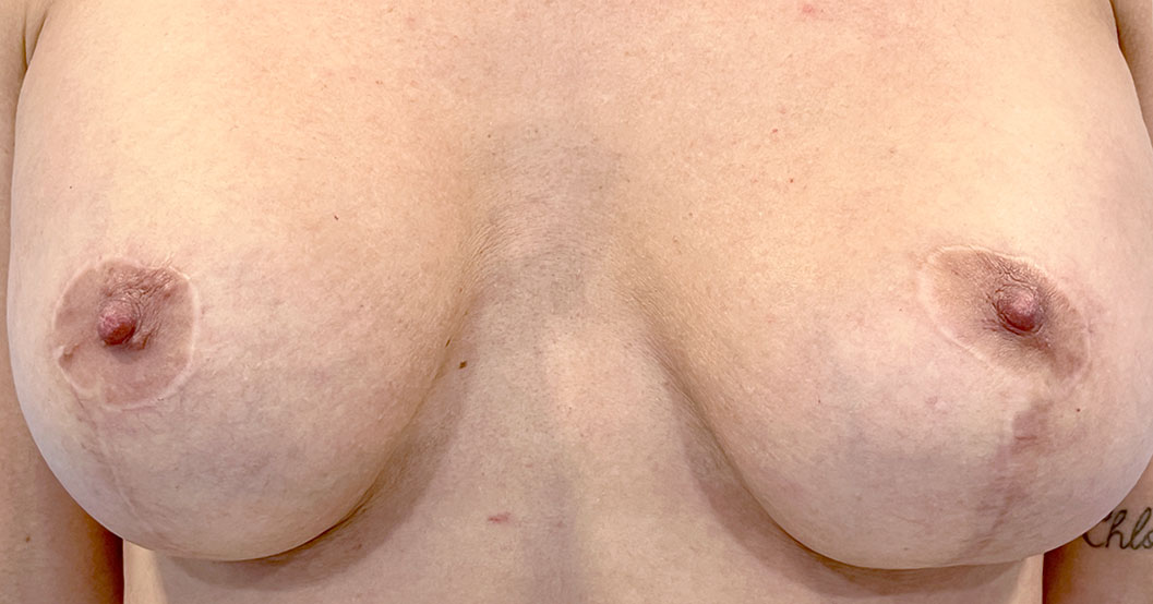 eliminar-cicatrices-en-las-aureolas