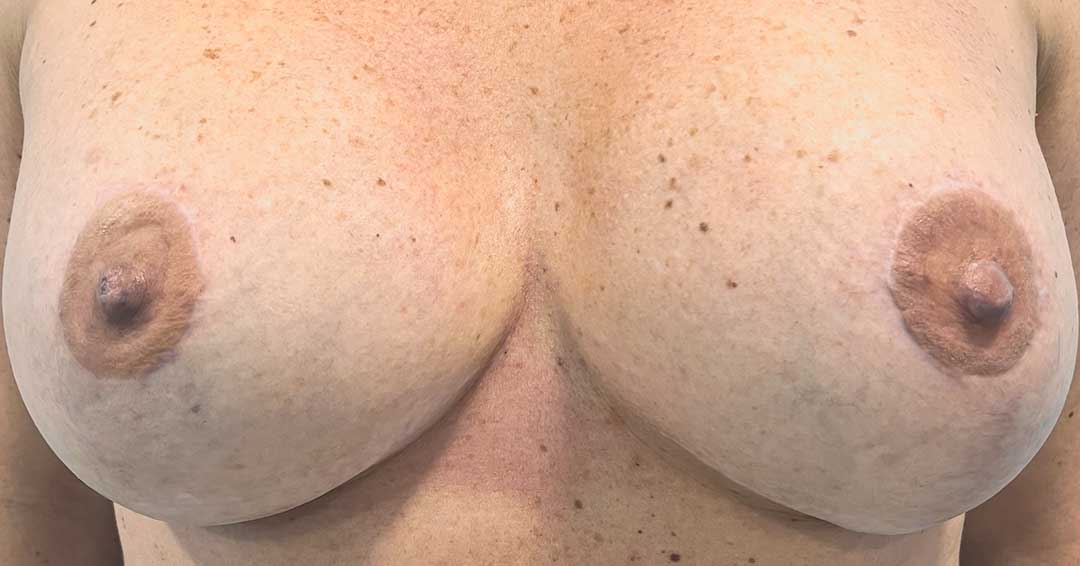 eliminar-cicatrices-oscuras-en-el-pecho-2