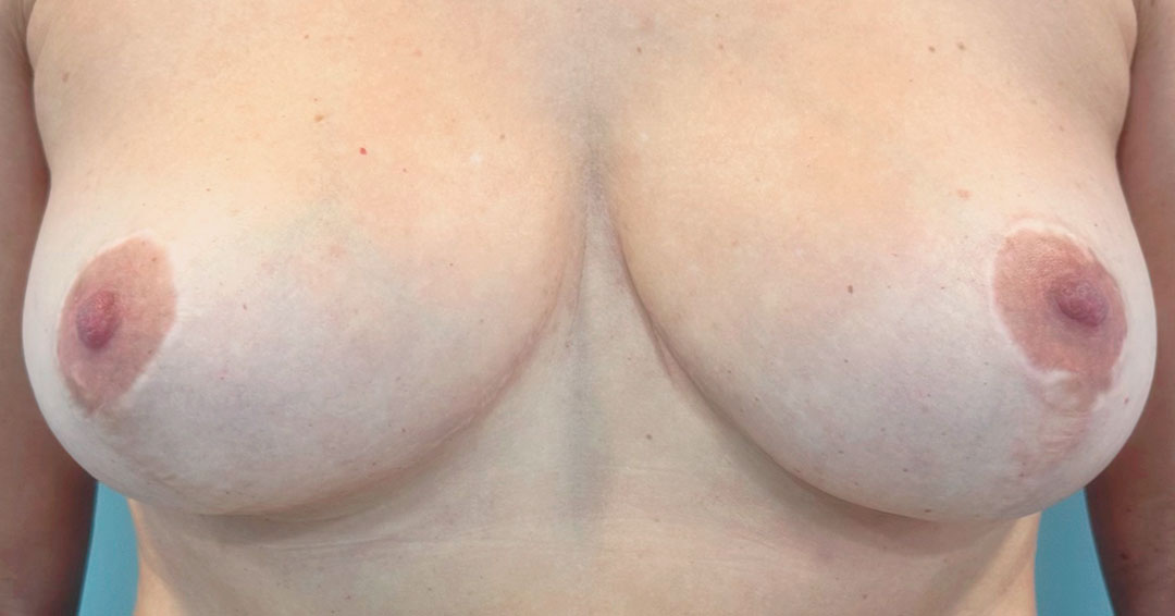 mejorar-areola-despues-de-reduccion-de-pecho-barcelona
