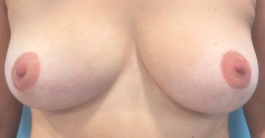 mejorar-cicatriz-despues-de-reduccion-de-pecho-barcelona