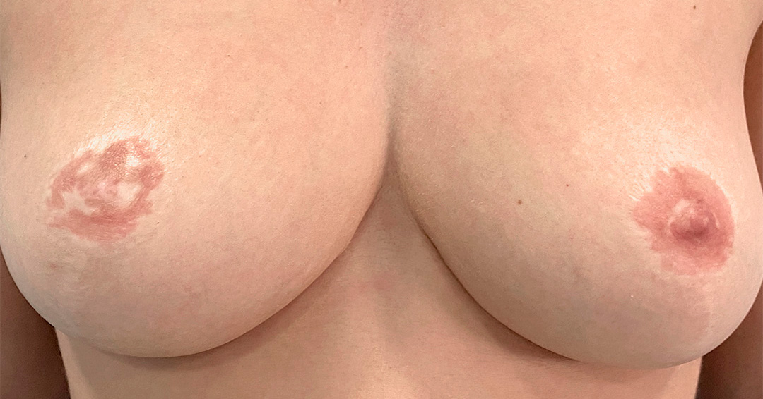 mejorar-el-color-de-areolas-despigmentadas