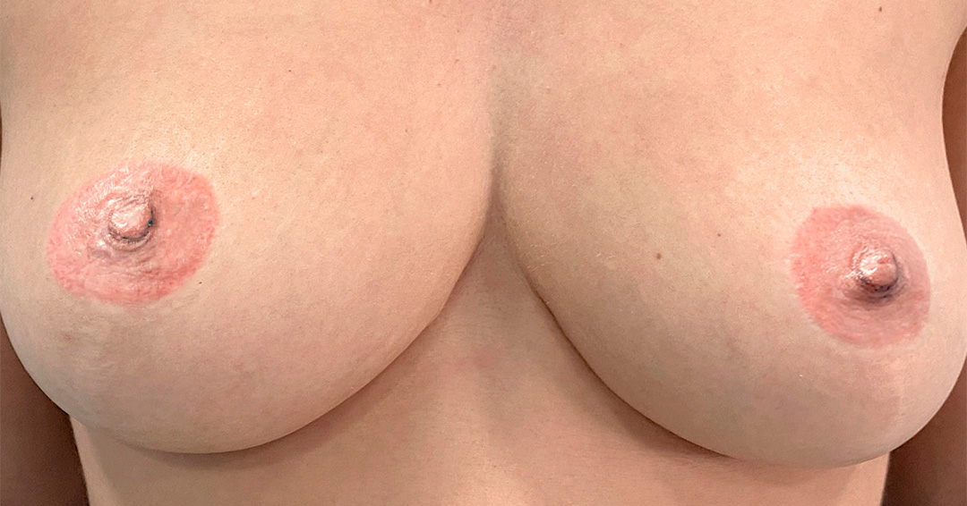 mejorar-el-color-de-las-areolas