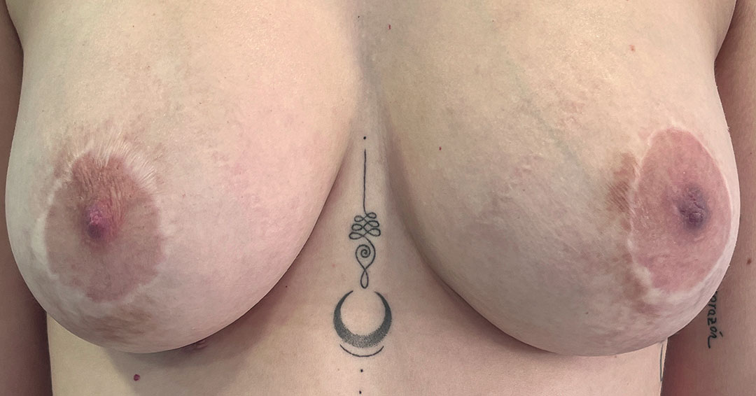 mejorar-textura-y-color-de-cicatrices-de-pecho-en-barcelona
