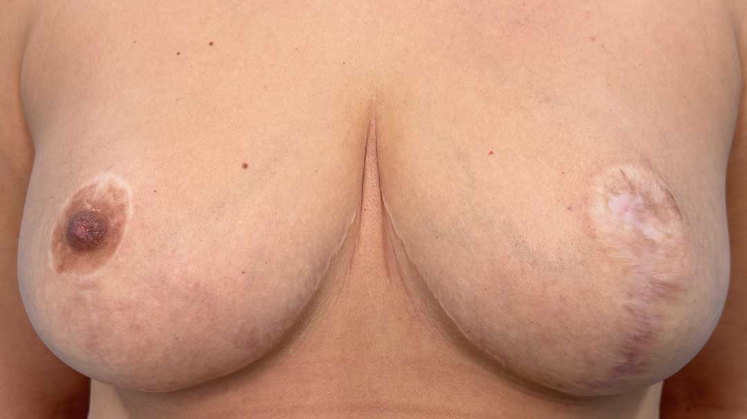 reconstruccion-de-areolas-con-micropigmentacion-antes-y-despues-en-barcelona