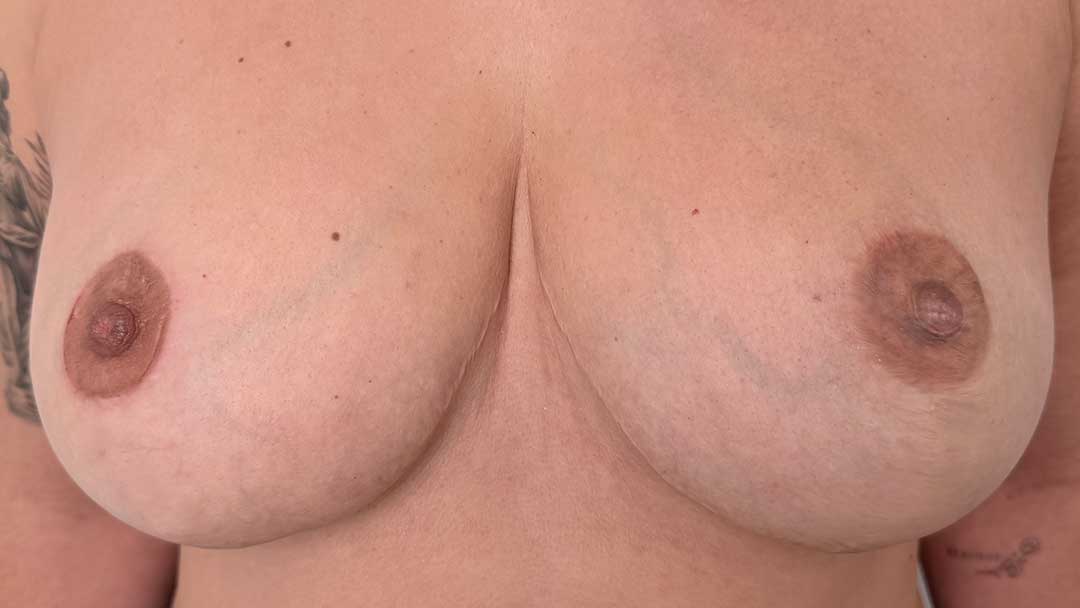 reconstruccion-de-areolas-con-micropigmentacion-antes-y-despues