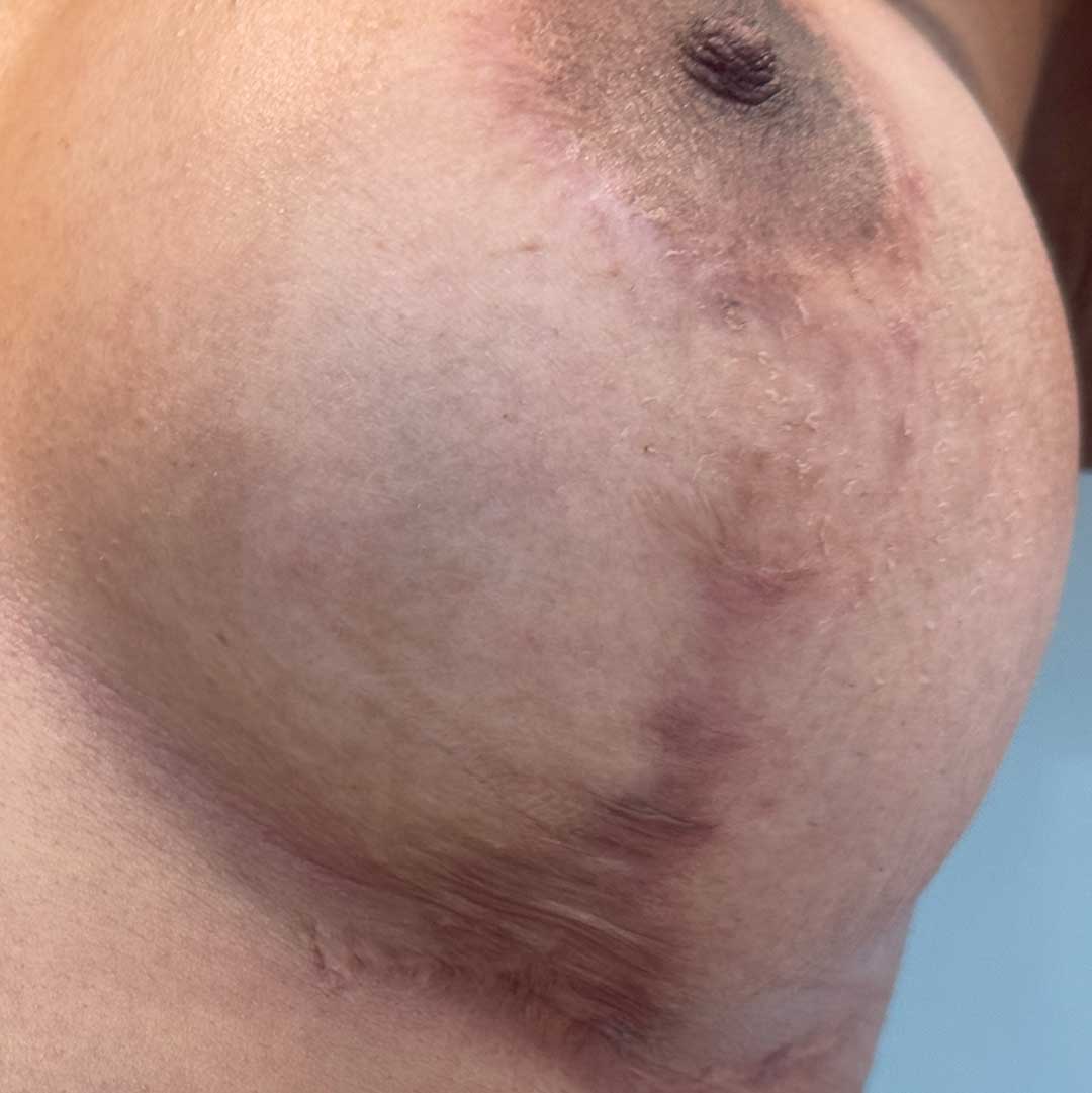 resultado-del-camuflaje-de-cicatries-de-mastopexia-antes-y-despues