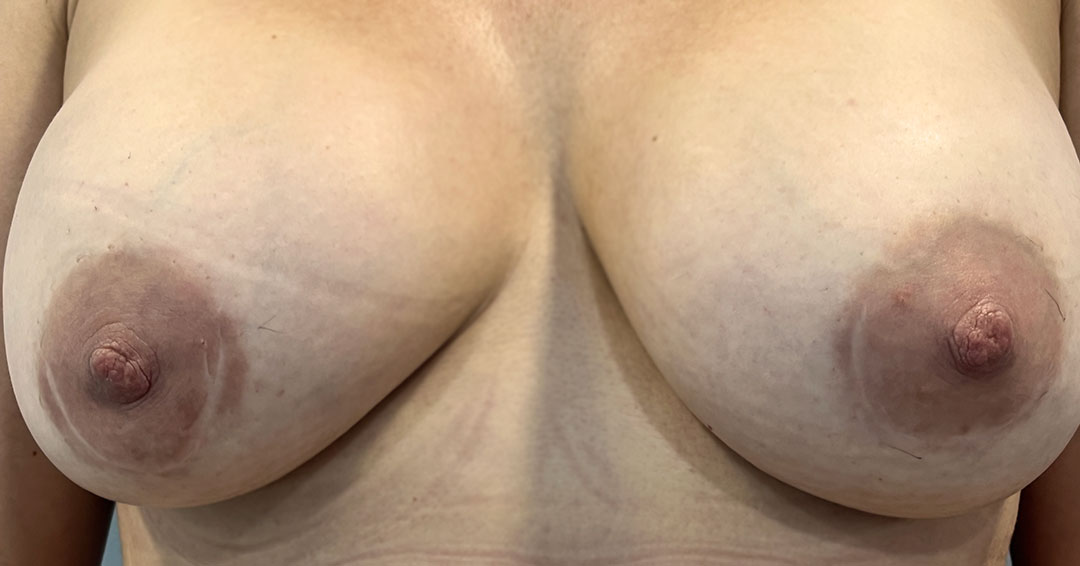 tapar-cicatriz-tras-operacion-de-pecho-en-barcelona