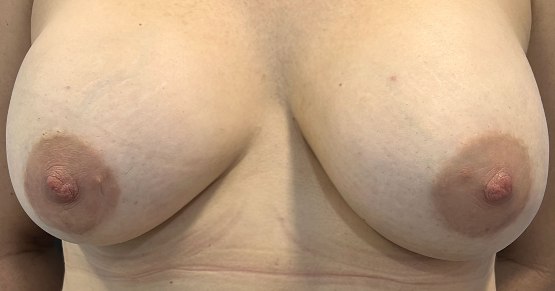 tapar-cicatriz-tras-operacion-de-pecho