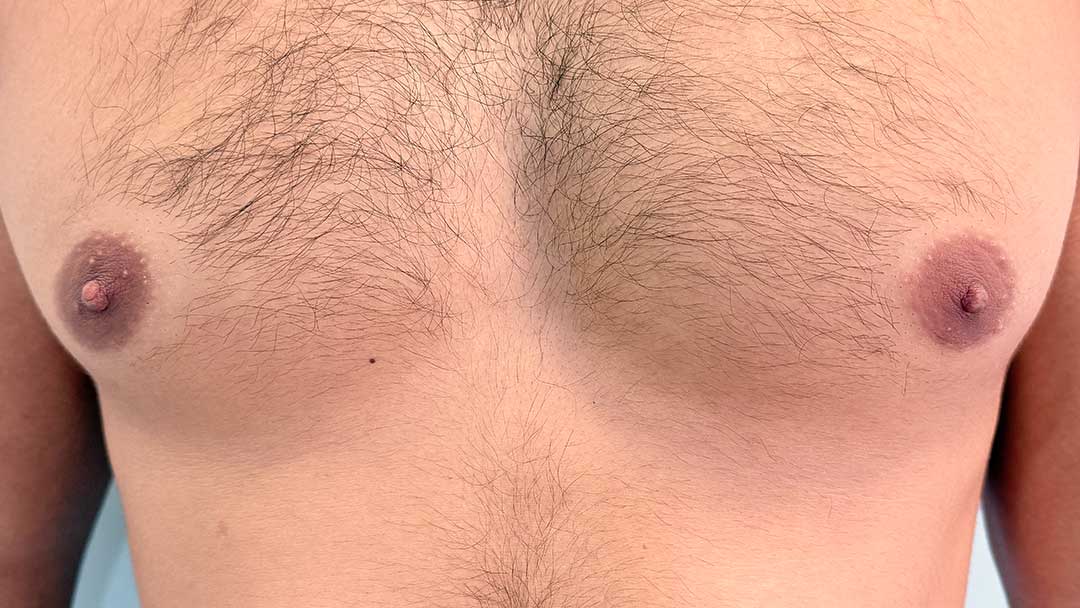 disimular-cicatrices-en-el-pecho-tras-ginecomastia-en-barcelona