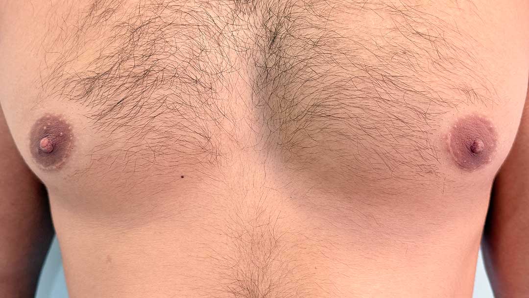 disimular-cicatrices-en-el-pecho-tras-ginecomastia