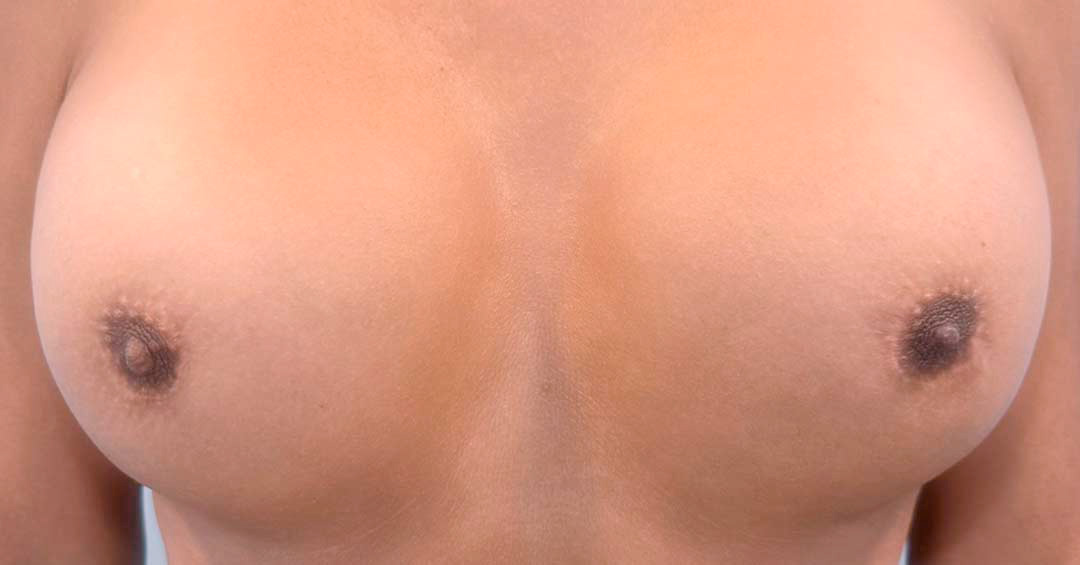 mejorar-areola-despues-de-cambio-de-sexo-barcelona