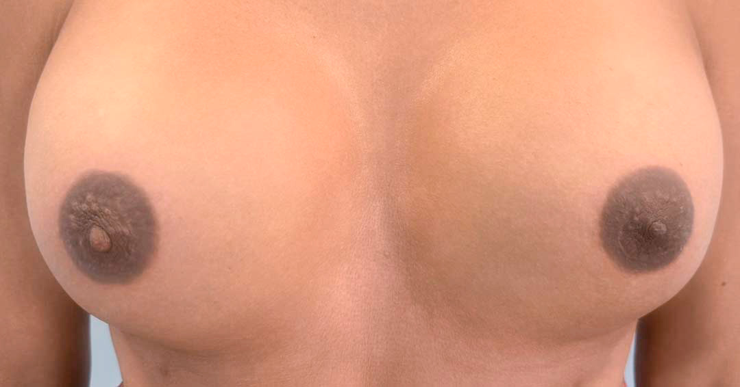 mejorar-aureola-despues-de-cambio-de-sexo