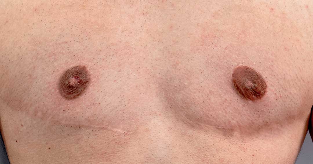 reconstrucion-areolar-tras-cambio-de-sexo