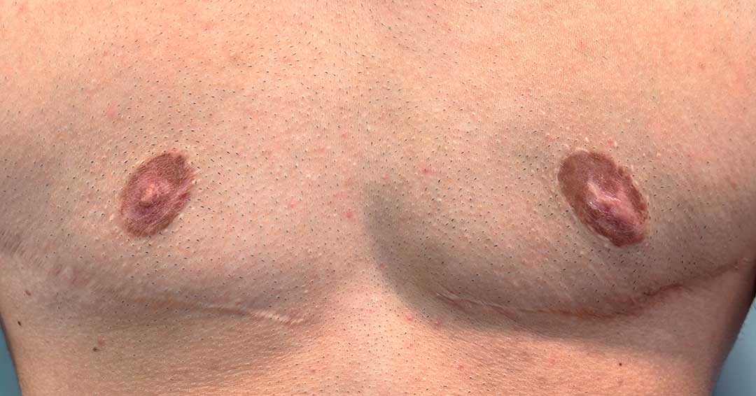 reconstrucion-areolar-tras-reasignacion-de-sexo