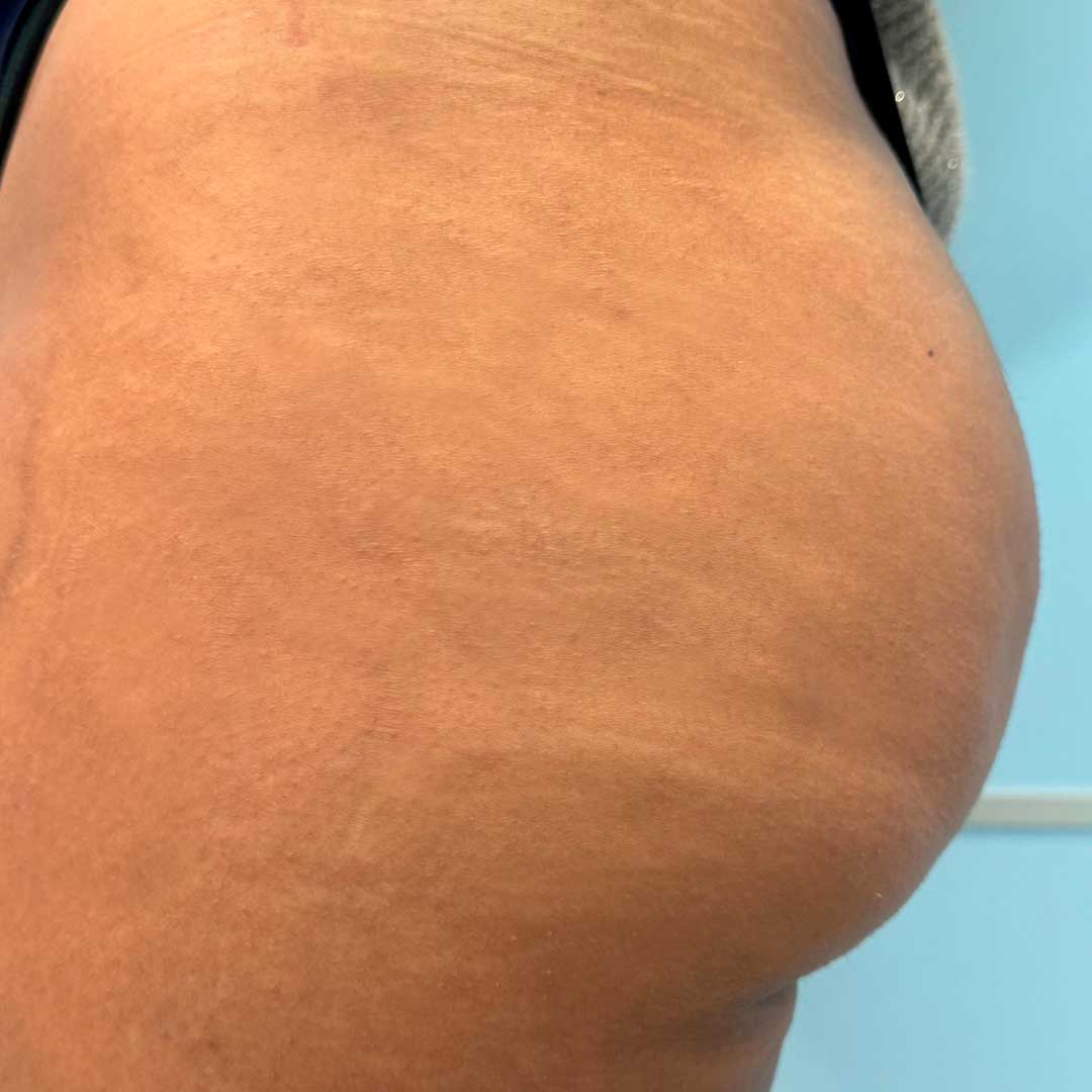 tratamiento-para-camuflar--las-estrias-resultados-antes-y-despues